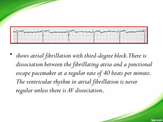 • shows atrial fibrillation with third-degree block.There is
dissociation between the fibrillating atria and a junctional
escape pacemaker at a regular rate of 40 beats per minute.
The ventricular rhythm in atrial fibrillation is never
regular unless there is AV dissociation.
 