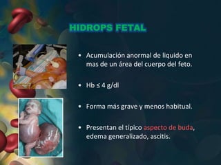 HIDROPS FETAL
• Acumulación anormal de liquido en
mas de un área del cuerpo del feto.
• Hb ≤ 4 g/dl
• Forma más grave y menos habitual.
• Presentan el típico aspecto de buda,
edema generalizado, ascitis.
 