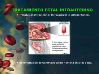 TRATAMIENTO FETAL INTRAUTERINO
• Transfusión intrauterino: Intravascular e intraperitoneal.
• Administración de Gammaglobulina humana en altas dosis.
 