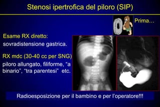 Stenosi ipertrofica del piloro (SIP)
                                                      Prima…

Esame RX diretto:
sovradistensione gastrica.

RX mdc (30-40 cc per SNG)
piloro allungato, filiforme, “a
binario”, “tra parentesi” etc.



      Radioesposizione per il bambino e per l’operatore!!!
 