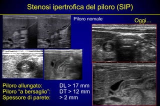 Stenosi ipertrofica del piloro (SIP)
                            Piloro nomale        Oggi…




Piloro allungato:       DL > 17 mm
Piloro “a bersaglio”:   DT > 12 mm
Spessore di parete:     > 2 mm
 