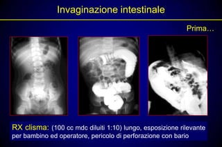 Invaginazione intestinale
                                                           Prima…




RX clisma: (100 cc mdc diluiti 1:10) lungo, esposizione rilevante
per bambino ed operatore, pericolo di perforazione con bario
 