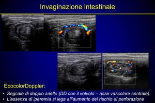 Invaginazione intestinale




EcocolorDoppler:
• Segnale di doppio anello (DD con il volvolo – asse vascolare centrale).
• L’assenza di iperemia si lega all’aumento del rischio di perforazione
 