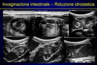 Invaginazione intestinale – Riduzione idrostatica
 