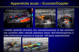 Appendicite acuta – EcocolorDoppler




L’analisi spettrale dimostra una vascolarizzazione di tipo arterioso
con aumento della velocità diastolica (tipico dell’infiammazione) e
nella perforazione assenza di segnale nell’apice appendicolare
 