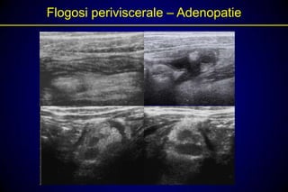 Flogosi periviscerale – Adenopatie
 