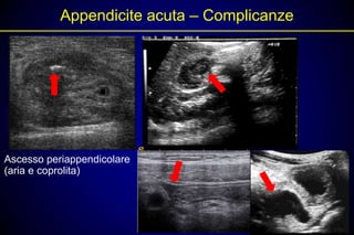 Appendicite acuta – Complicanze




Ascesso periappendicolare
(aria e coprolita)
 