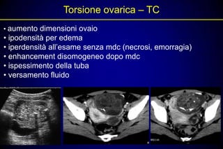 Torsione ovarica – TC
• aumento dimensioni ovaio
• ipodensità per edema
• iperdensità all’esame senza mdc (necrosi, emorragia)
• enhancement disomogeneo dopo mdc
• ispessimento della tuba
• versamento fluido
 
