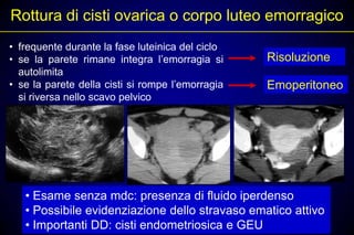 Rottura di cisti ovarica o corpo luteo emorragico
• frequente durante la fase luteinica del ciclo
• se la parete rimane integra l’emorragia si      Risoluzione
  autolimita
• se la parete della cisti si rompe l’emorragia   Emoperitoneo
  si riversa nello scavo pelvico




   • Esame senza mdc: presenza di fluido iperdenso
   • Possibile evidenziazione dello stravaso ematico attivo
   • Importanti DD: cisti endometriosica e GEU
 