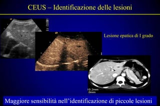 CEUS – Identificazione delle lesioni


                                        Lesione epatica di I grado




Maggiore sensibilità nell’identificazione di piccole lesioni
 