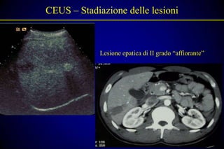 CEUS – Stadiazione delle lesioni



             Lesione epatica di II grado “affiorante”
 