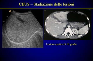 CEUS – Stadiazione delle lesioni




               Lesione epatica di III grado
 
