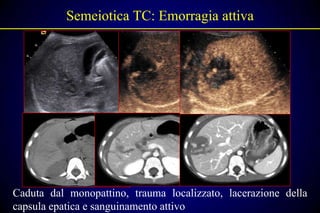 Semeiotica TC: Emorragia attiva




Caduta dal monopattino, trauma localizzato, lacerazione della
capsula epatica e sanguinamento attivo
 