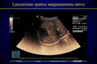 Lacerazione epatica sanguinamento attivo
 