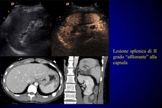 Lesione splenica di II
grado “affiorante” alla
capsula
 
