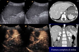 Frattura completa di milza
 