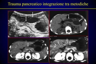 Trauma pancreatico integrazione tra metodiche
 