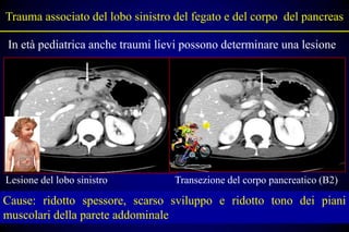 Trauma associato del lobo sinistro del fegato e del corpo del pancreas

In età pediatrica anche traumi lievi possono determinare una lesione




Lesione del lobo sinistro          Transezione del corpo pancreatico (B2)

Cause: ridotto spessore, scarso sviluppo e ridotto tono dei piani
muscolari della parete addominale
 