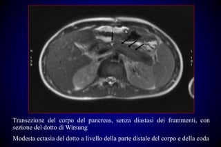 Transezione del corpo del pancreas, senza diastasi dei frammenti, con
sezione del dotto di Wirsung
Modesta ectasia del dotto a livello della parte distale del corpo e della coda
 
