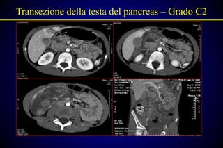 Transezione della testa del pancreas – Grado C2
 