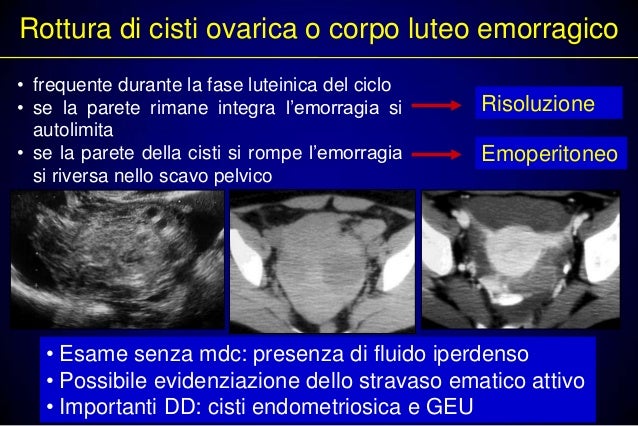Corpo Luteo Emorragico Si Riassorbe