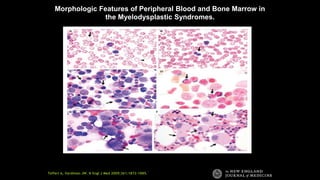 Tefferi A, Vardiman JW. N Engl J Med 2009;361:1872-1885.
Morphologic Features of Peripheral Blood and Bone Marrow in
the Myelodysplastic Syndromes.
 