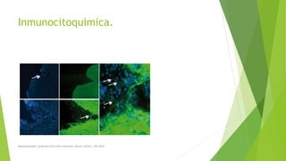 Inmunocitoquimica.
Myelodysplastic Syndrome Overview American cáncer society. Año 2014
 