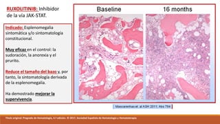 RUXOLITINIB: Inhibidor
de la vía JAK-STAT.
Indicado: Esplenomegalia
sintomática y/o sintomatología
constitucional.
Muy eficaz en el control: la
sudoración, la anorexia y el
prurito.
Reduce el tamaño del bazo y, por
tanto, la sintomatología derivada
de la esplenomegalia.
Ha demostrado mejorar la
supervivencia.
Título original: Pregrado de Hematología, 4.ª edición. © 2017, Sociedad Española de Hematología y Hematoterapia
 