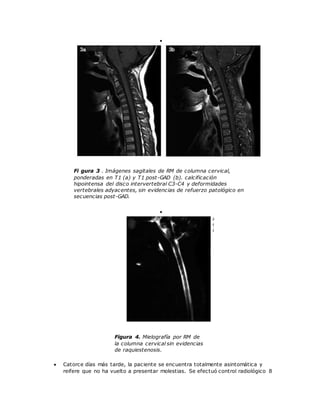  
Fi gura 3 . Imágenes sagitales de RM de columna cervical, 
ponderadas en T1 (a) y T1 post-GAD (b). calcificación 
hipointensa del disco intervertebral C3-C4 y deformidades 
vertebrales adyacentes, sin evidencias de refuerzo patológico en 
secuencias post-GAD. 
 
Figura 4. Mielografía por RM de 
la columna cervical sin evidencias 
de raquiestenosis. 
 Catorce días más tarde, la paciente se encuentra totalmente asintomática y 
reifere que no ha vuelto a presentar molestias. Se efectuó control radiológico 8 
 