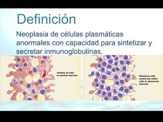 Definición
Neoplasia de células plasmáticas
anormales con capacidad para sintetizar y
secretar inmunoglobulinas.
 