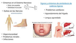• Síntomas en el Sistema Nervioso
• Dolor de espalda
• Debilidad muscular
• Daños en los Nervios
• Hiperviscosidad
• Problemas renales
• Infecciones
Signos y síntomas de amiloidosis de
cadenas ligeras
• Problemas cardíacos:
• Agrandamiento del hígado
• Lengua agrandada
 