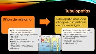 Riñón de mieloma
•Cilindros multilamelares
fracturados, Eosinofilicos
•HE+, PAS, rojo congo, tioflavina
•TD,TC,TP
•Prot. TammHorsfall
•Lento FG, ácidez NefD, ES
(NaCl)
•MbasalL + Macrófagos
•Granular
Tubulopatía asociada
al deposito intersticial
de cadenas ligeras
•Infiltrado intersticial de LT, cel
plasmáticas & eosinofilos por un
daño tubular activo
•Cadenas ligeras, infiltado
inflamatorio
•Pb lesión glomerular
•+IRA-Proteinuria
 