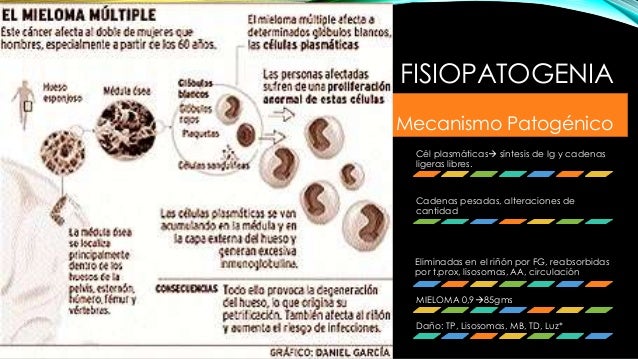 mieloma cadenas kappa mieloma m 250 ltiple mieloma cadenas kappa mieloma m 250 ltiple