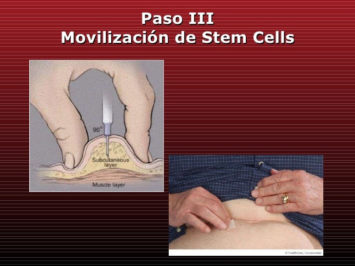 Trasplante de Células Madre para pacientes con Mieloma Trasplante de Células Madre para pacientes con Mieloma