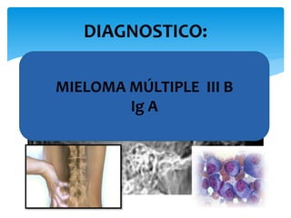 DIAGNOSTICO: 
MIELOMA MÚLTIPLE III B 
Ig A 
 