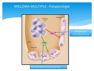 MIELOMA MÚLTIPLE - Fisiopatología 
ACTIVACION OSTEOCLASTICA 
INHIBICION 
OSTEOBLASTICA 
 