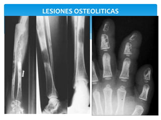 LESIONES OSTEOLITICAS 
 