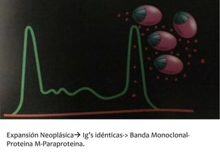 Expansión Neoplásica Ig’s idénticas-> Banda Monoclonal- 
ProteinaM-Paraproteina. 
 