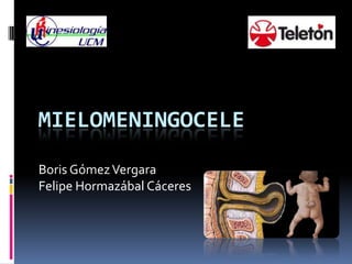 MIELOMENINGOCELE
Boris Gómez Vergara
Felipe Hormazábal Cáceres
 