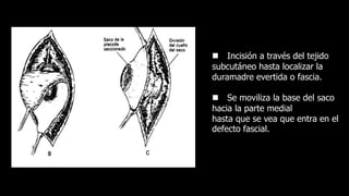  Incisión a través del tejido
subcutáneo hasta localizar la
duramadre evertida o fascia.
 Se moviliza la base del saco
hacia la parte medial
hasta que se vea que entra en el
defecto fascial.
 