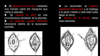  La duramadre se separa
mediante disección y se repliega
a la parte medial a cada lado hasta
llegar al cierre.
 Cierre de la fascia como
capa separada
 Se penetra en el saco mediante
una insición radial del manguito que
rodea la placoda.
 Se reseca la piel en una
circunferencia alrededor de la placoda.
 La placoda queda flotando
libremente dentro de la duramadre
evertida.
 