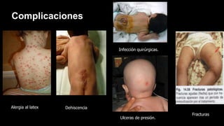 Ulceras de presión.
Complicaciones
Dehiscencia
Infección quirúrgicas.
Alergia al latex
Fracturas
 