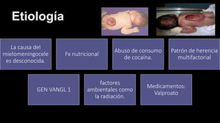 Etiología
La causa del
mielomeningocele
es desconocida.
Fx nutricional
Abuso de consumo
de cocaína.
Patrón de herencia
multifactorial
GEN VANGL 1
factores
ambientales como
la radiación.
Medicamentos:
Valproato
 