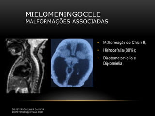 MIELOMENINGOCELE
MALFORMAÇÕES ASSOCIADAS
• Malformação de Chiari II;
• Hidrocefalia (80%);
• Diastematomielia e
Diplomielia;
DR. PETERSON XAVIER DA SILVA
MEDPETERSON@HOTMAIL.COM
 