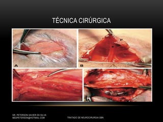 TÉCNICA CIRÚRGICA
DR. PETERSON XAVIER DA SILVA
MEDPETERSON@HOTMAIL.COM TRATADO DE NEUROCIRURGIA SBN
 