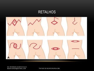 RETALHOS
DR. PETERSON XAVIER DA SILVA
MEDPETERSON@HOTMAIL.COM TRATADO DE NEUROCIRURGIA SBN
 