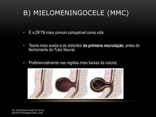 B) MIELOMENINGOCELE (MMC)
• É a DFTN mais comum compatível coma vida
• Teoria mais aceita é do distúrbio da primeira neurulação, antes do
fechamento do Tubo Neural;
• Preferencialmente nas regiões mais baixas da coluna;
DR. PETERSON XAVIER DA SILVA
MEDPETERSON@HOTMAIL.COM
 