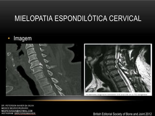 MIELOPATIA ESPONDILÓTICA CERVICAL
• Imagem
British Editorial Society of Bone and Joint 2012
 