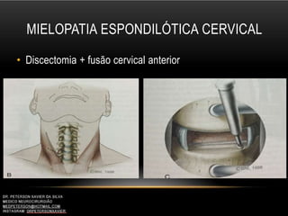MIELOPATIA ESPONDILÓTICA CERVICAL
• Discectomia + fusão cervical anterior
 