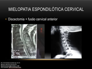 MIELOPATIA ESPONDILÓTICA CERVICAL
• Discectomia + fusão cervical anterior
 